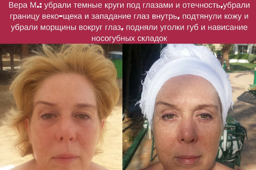 Хочу убрать морщины Хочу убрать морщины