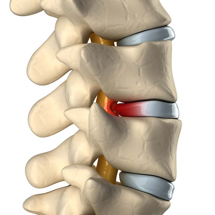 Spinal cord under pressure