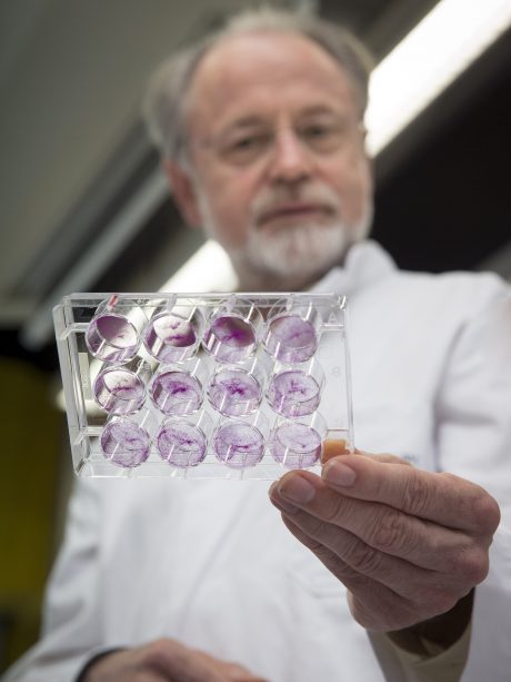 Onderzoeker met een schaaltje met gekweekte tumorcellen