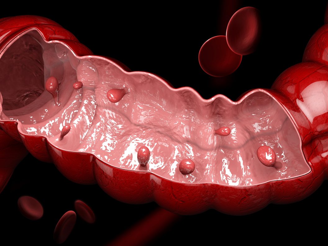 3d,Illustration,Of,Colon,Polyps.,Polyp,In,The,Intestine.,Isolated
