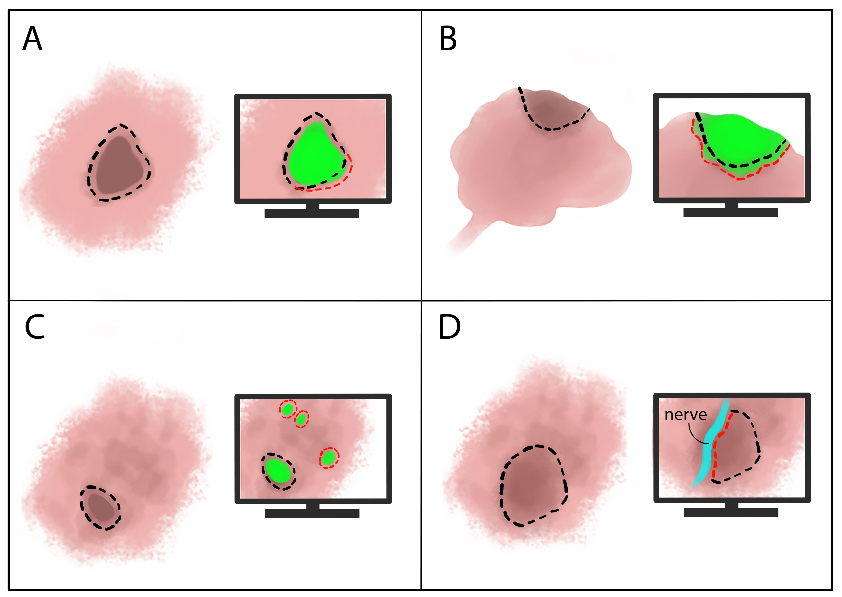 Op basis van de fluorescentie (groen) kan de chirurg afwijken van het orginele operatieplan (zwarte versus rode stippellijn)