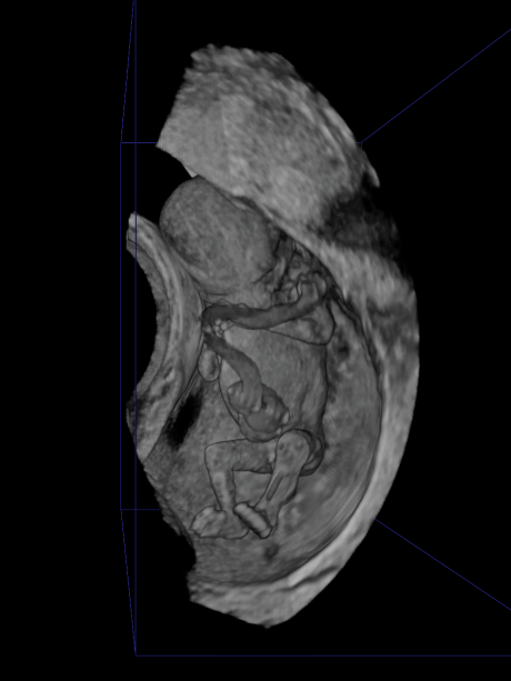 Foetus van 58mm, 11-12 weken.