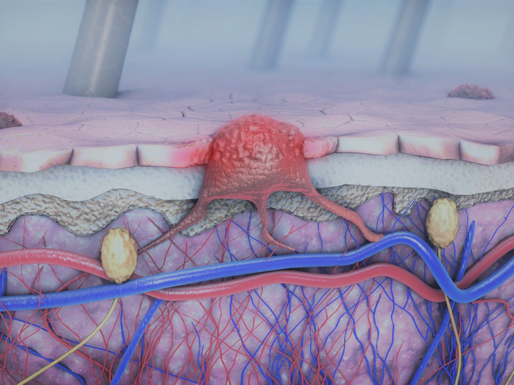 3d,Illustration,Of,A,Cross-section,Of,A,Diseased,Skin,With
