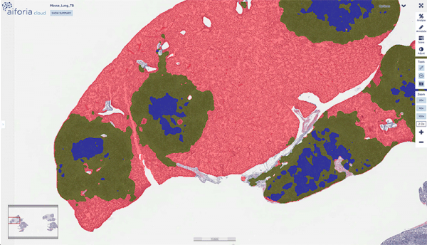 Tuberculosis lesion detection with AI