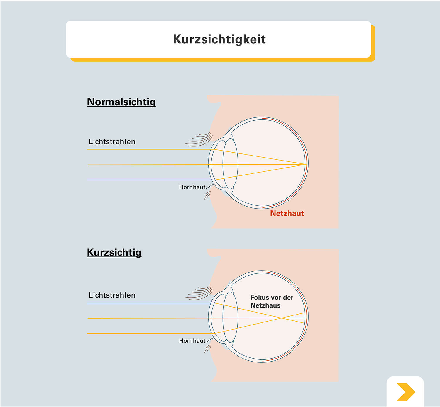 Den Ursachen Der Kurzsichtigkeit Auf Der Spur