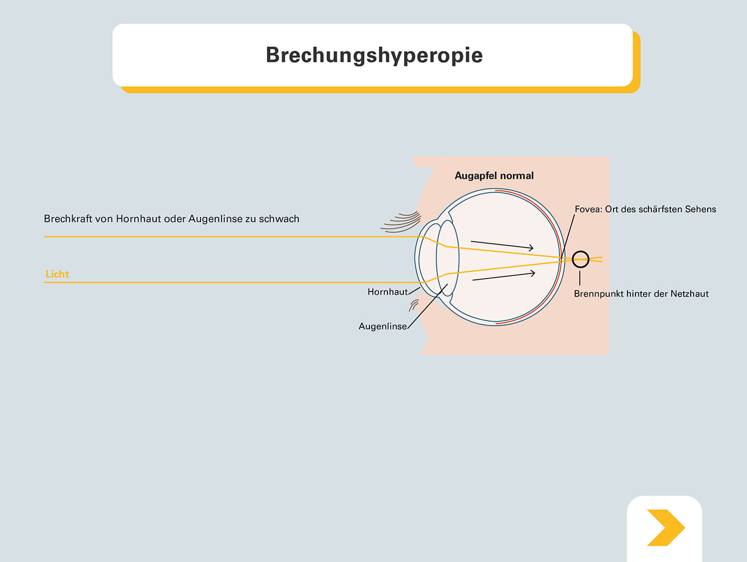 Weitsichtigkeit Wenn Der Alltag Ohne Brille Unmoglich Wird