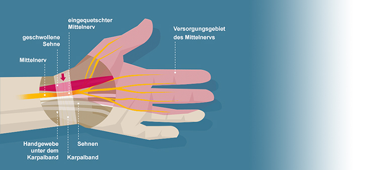 Karpaltunnelsyndrom-Darstellung-Handverletzungen