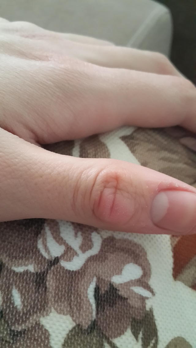 Parmağımın üstündeki şişlik, yara nasıl geçer?