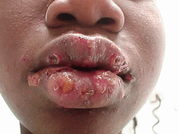 Herpes simplex virüsüne yakalandım. Tedavisi için önerisi olan var mı?
