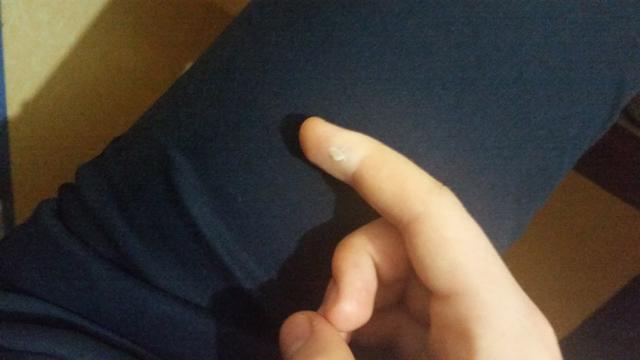 Parmağımin derisi kalkmış sizce koparmali miyim(Resimli)?