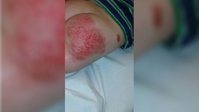 Chemisch middel op glijbaan; Kinderen met ernstige brandwonden (update) - OnsWestfriesland.nl