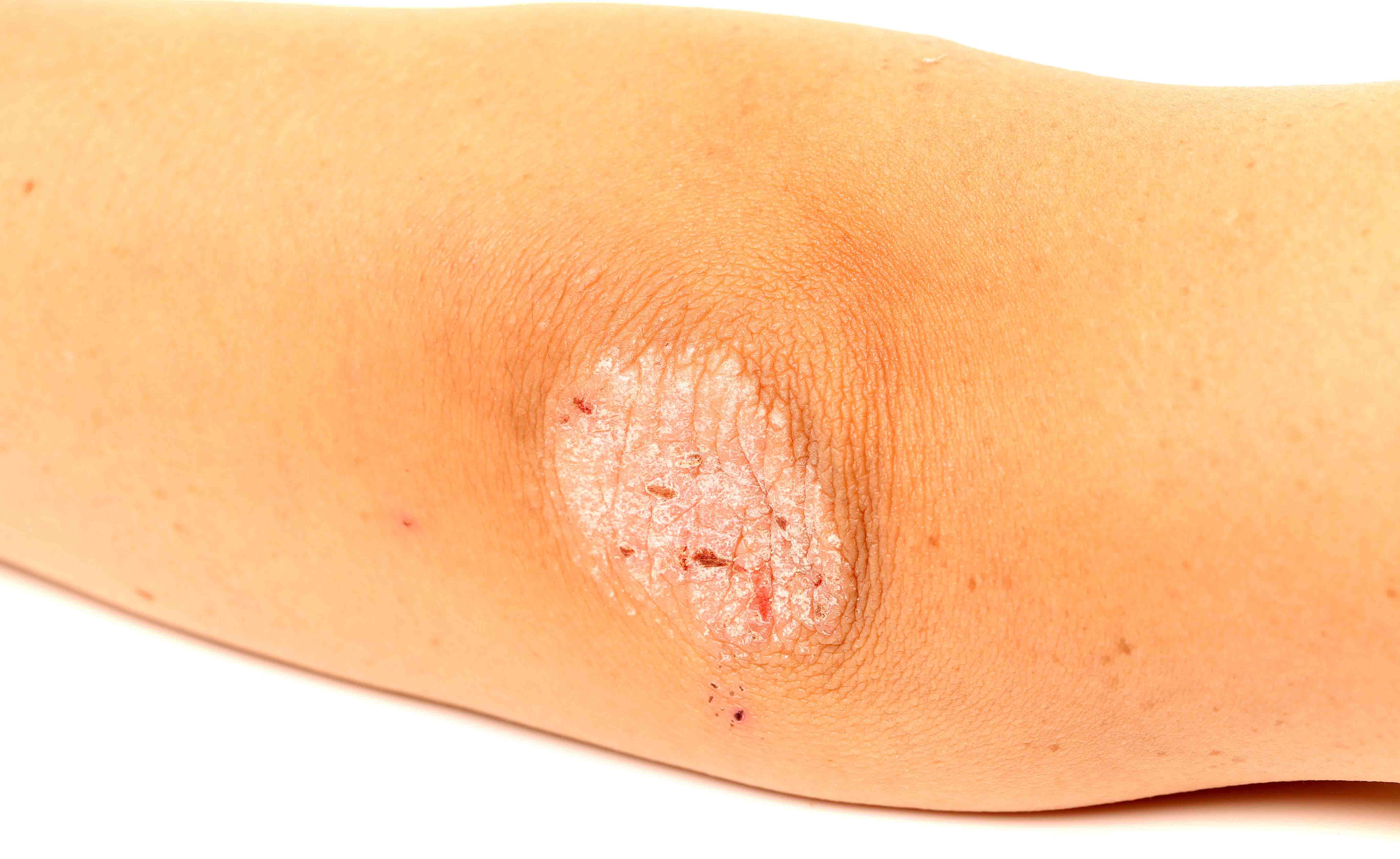 Quali di stelle hanno la psoriasi