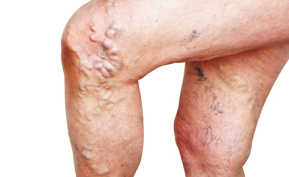 Il thrombophlebitis e per trattarlo i rimedi di gente