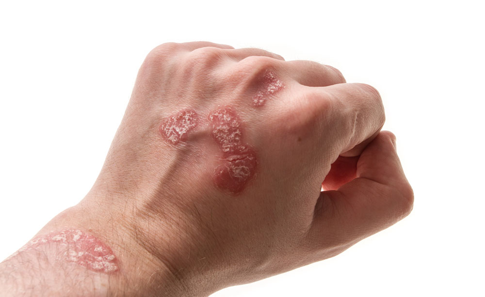 Che curare la psoriasi su rimedi di gente di faccia