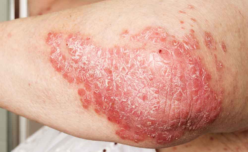 Come trattare il lievito di psoriasi
