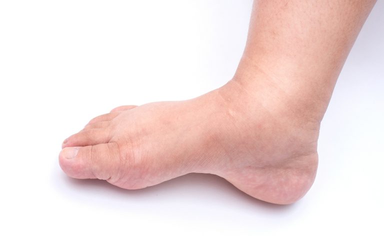 Come trattare un linfedema con la fisioterapia | Pazienti.it