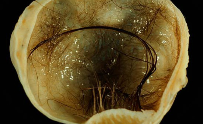 Trovato un piccolo cervello in un tumore all’ovaio | Pazienti.it