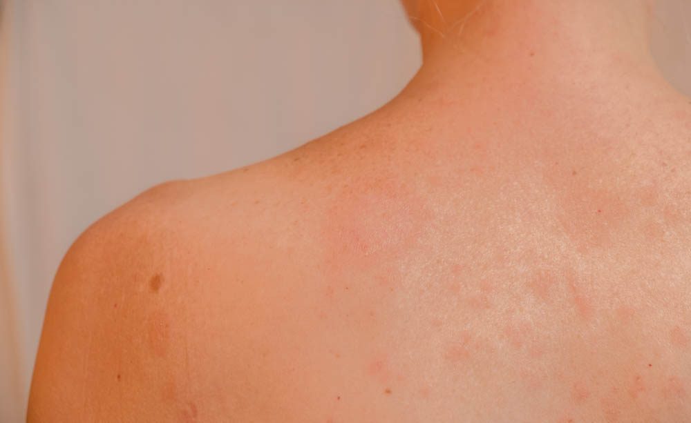 Sanatori della Turchia su cura di psoriasi