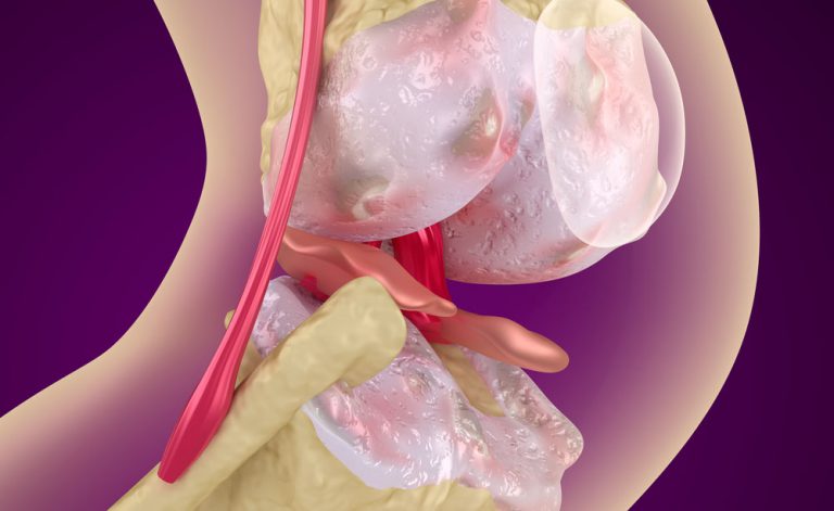 Curare l’artrosi con le cellule del naso: scopriamo come | Pazienti.it