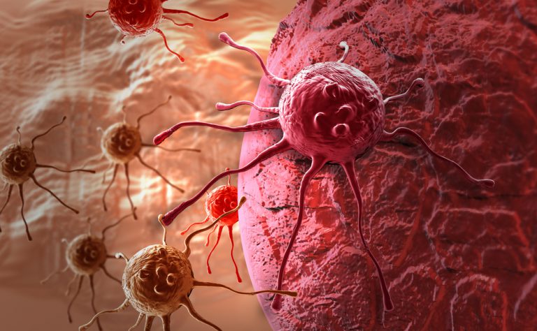 Tumore al cervello: ecco il laser per rimuoverlo | Pazienti.it