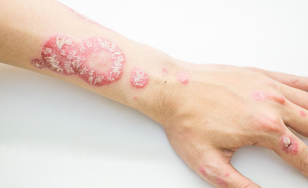 Psoriasi di trattamento sulla testa da una fotografia