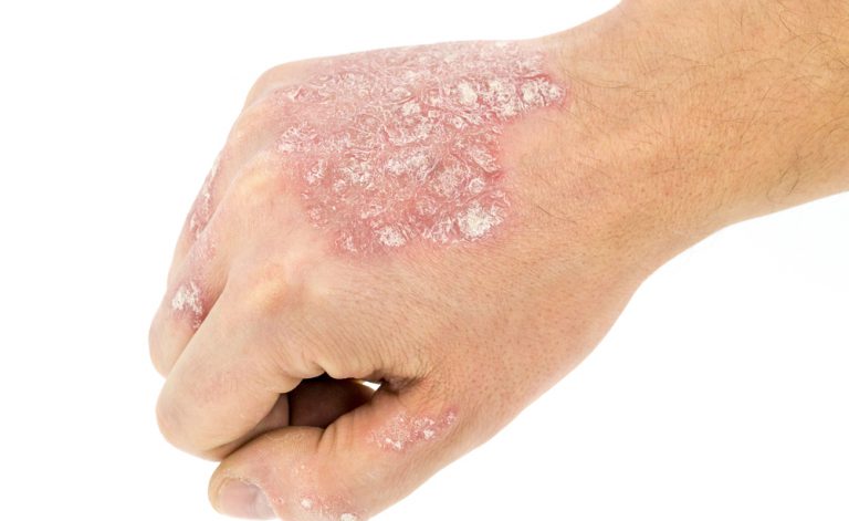 La psoriasi che questo e comè mostrato