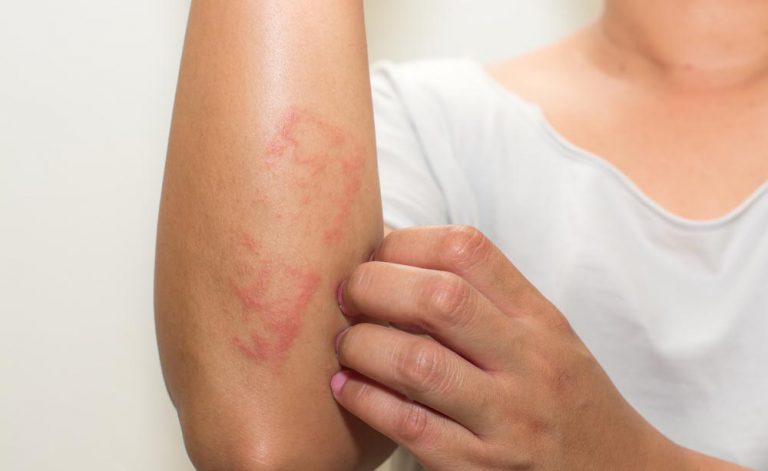 Se è possibile bere un assenzio a psoriasi