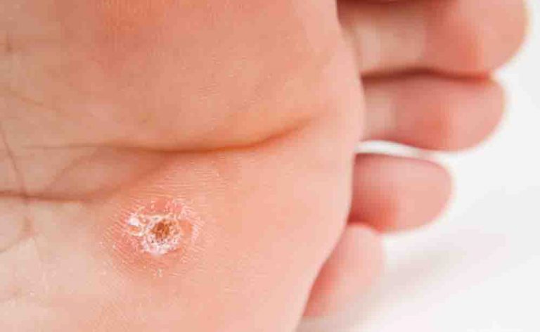 Come eliminare le verruche ai piedi | Pazienti.it
