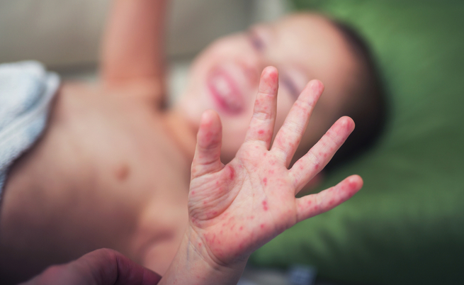 Roma, muore una bambina di 16 mesi. Aveva il morbillo | Pazienti.it