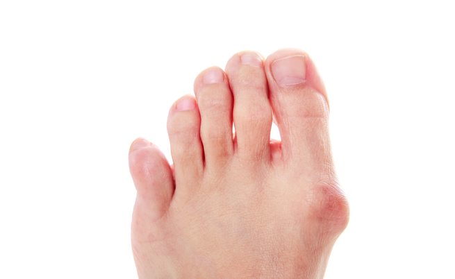 Alluce valgo: 5 esercizi che possono aiutare | Pazienti.it