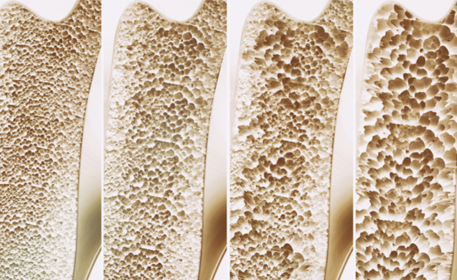 Osteoporosi: riconoscerla per curarla, anche in vacanza! | Pazienti.it