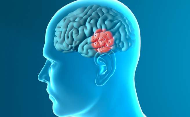 Parkinson, un farmaco per il diabete potrebbe bloccarlo | Pazienti.it