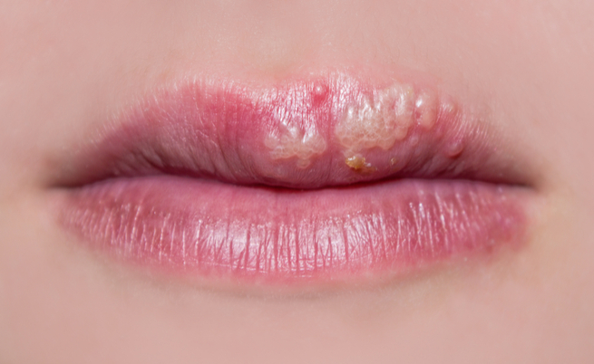 Herpes: perché compare con il cambio di stagione | Pazienti.it
