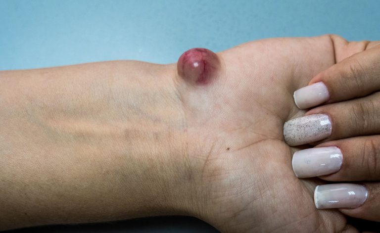 Hai una cisti? Probabilmente la causa è questa | Pazienti.it