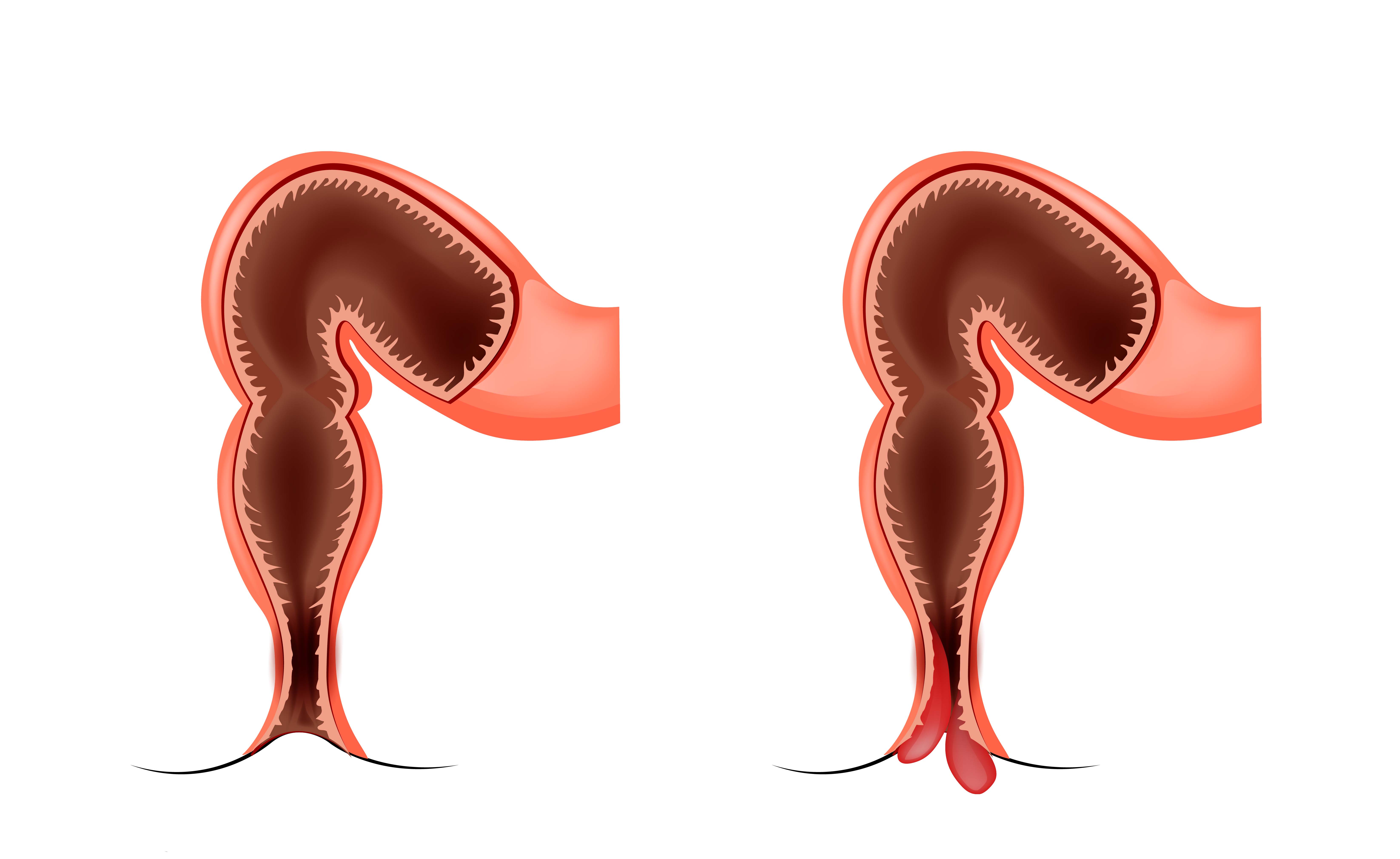 Dolori di gynecologic in passaggio posteriore