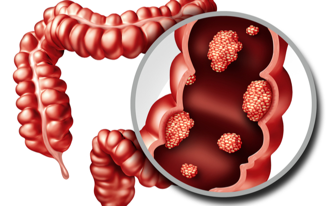 Carne rossa e tumore al colon: c’è un nesso causa-effetto? | Pazienti.it
