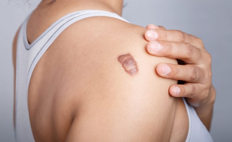 Cicatrice gonfia (ipertrofica): come eliminarla | Pazienti.it