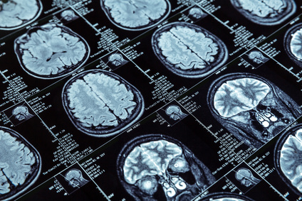 Was Hirnscans über den Mandelkern enthüllen
