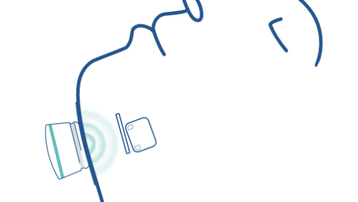 The Genio nerve stimulator is implanted under the chin to provide the bilateral stimulation of the hypoglossal nerve while you sleep.