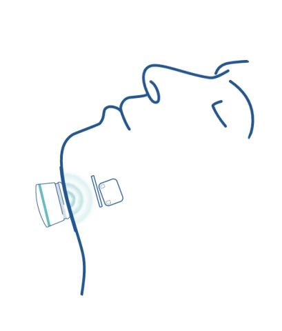 The Genio nerve stimulator is implanted under the chin to provide the bilateral stimulation of the hypoglossal nerve while you sleep.